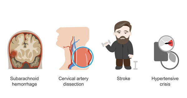 Thunderclap Headache