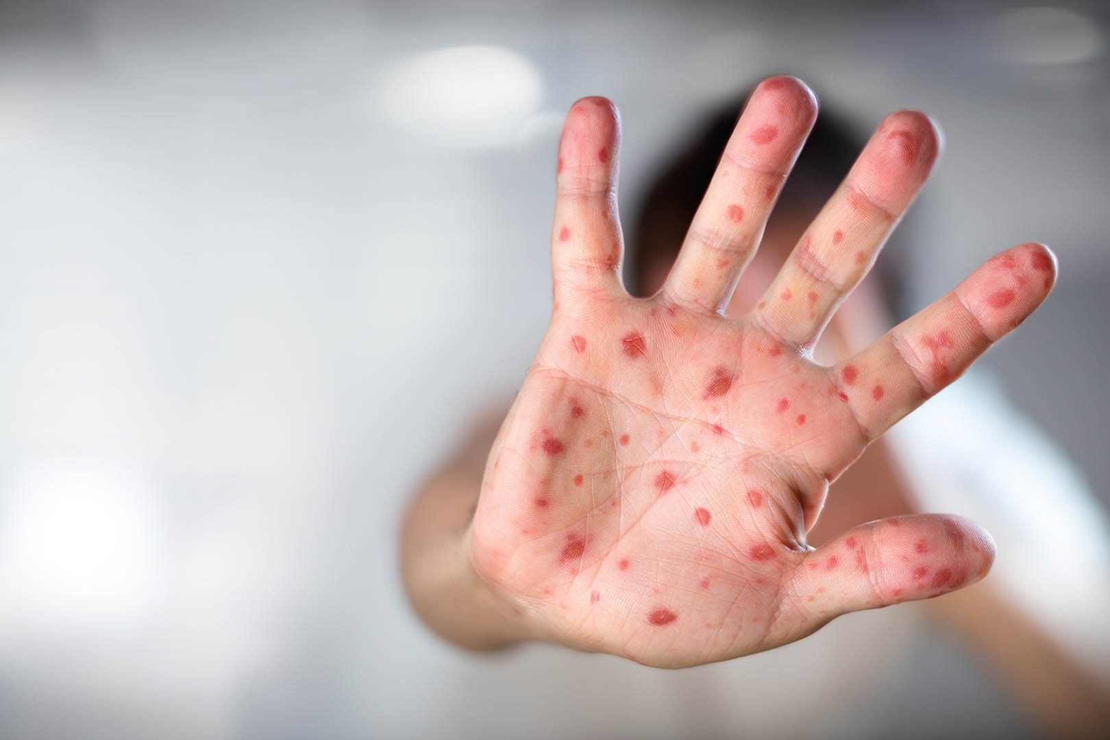 gejala Flu Singapura